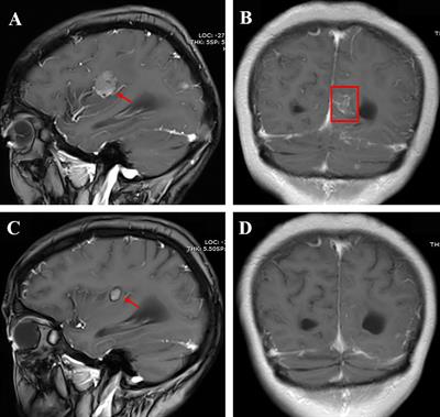 Case report: Almonertinib in combination with bevacizumab for leptomeningeal metastases from epidermal growth factor receptor-mutation non-small cell lung cancer: Case series